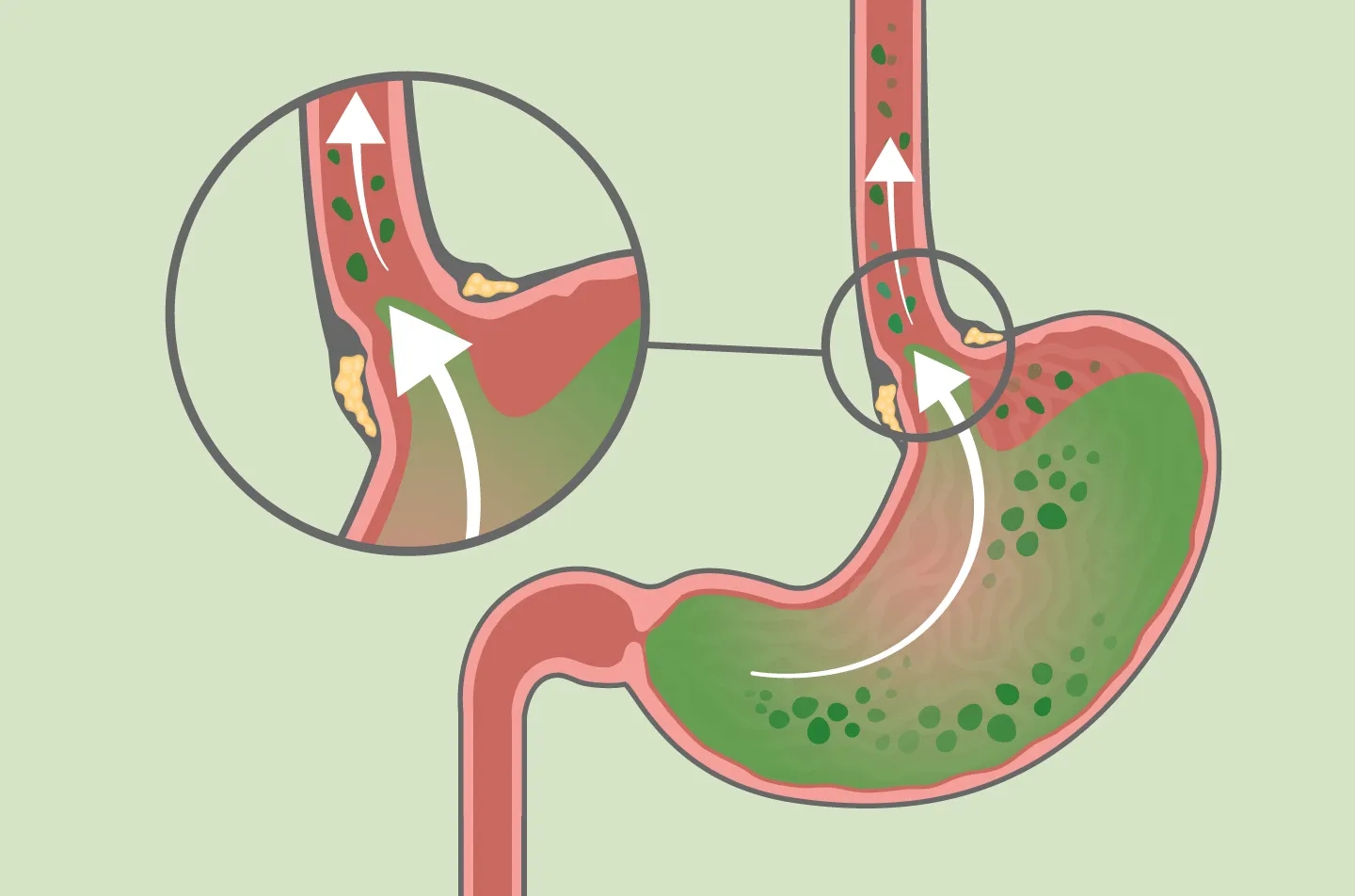 成都博仕胃肠病医院:反流的饮食注意事项 08胃酸反流是指胃酸逆流到