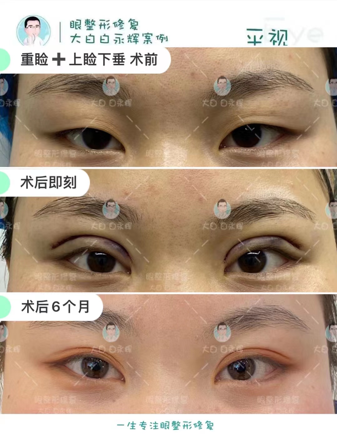 今日份分享 首次重睑77上睑下垂术后6个月 小美女的眼睛一直都是单