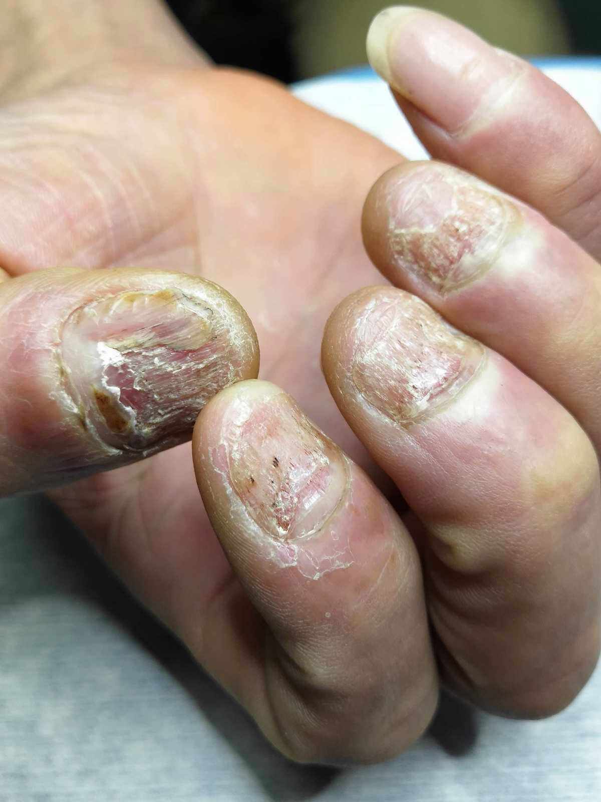 指甲真菌感染的症状图片