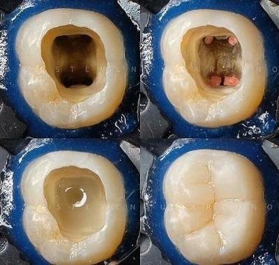 蛀虫和牙齿教具图片图片