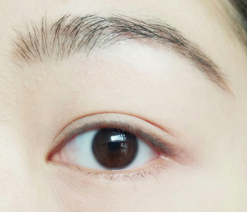 全切双眼皮7毫米恢复后多宽