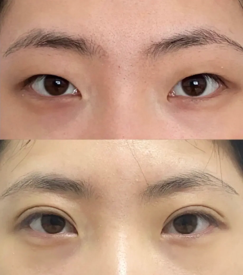 机压双眼皮 机压双眼皮效果一般是比较不错的.